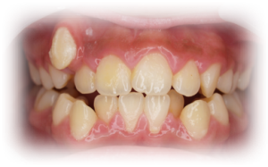Orthodontics Before Case 1 Orthodontics Before Case 1