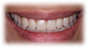 Orthodontics After Case 4 Orthodontics After Case 4
