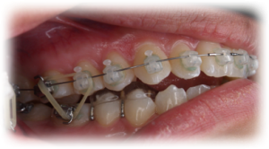 Orthodontics Before Case 5