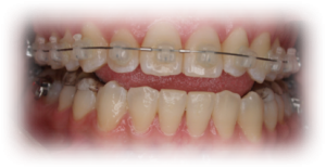 Orthodontics Before Case 6 Orthodontics Before Case 6