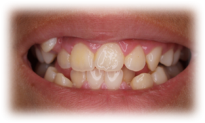 Orthodontics Before Case 3 Orthodontics Before Case 3