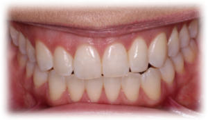 Orthodontics After Case 6 Orthodontics After Case 6